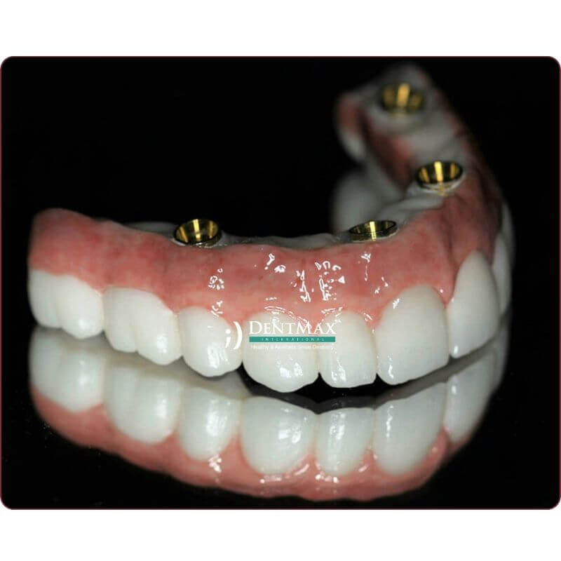 Dentmax