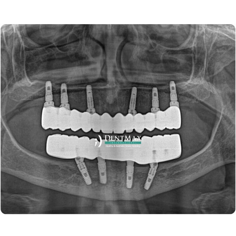 Dentmax