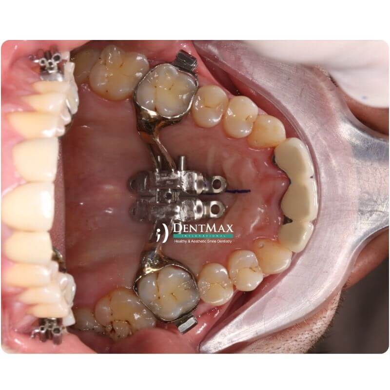 Dentmax