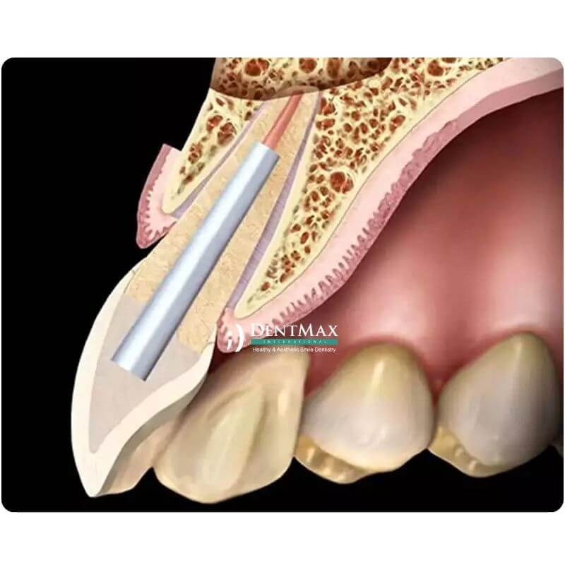 Dentmax
