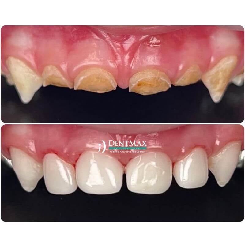 Dentmax