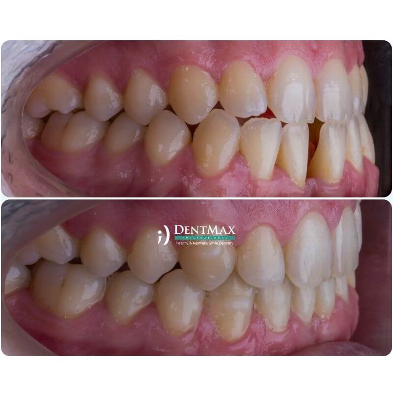 Dentmax