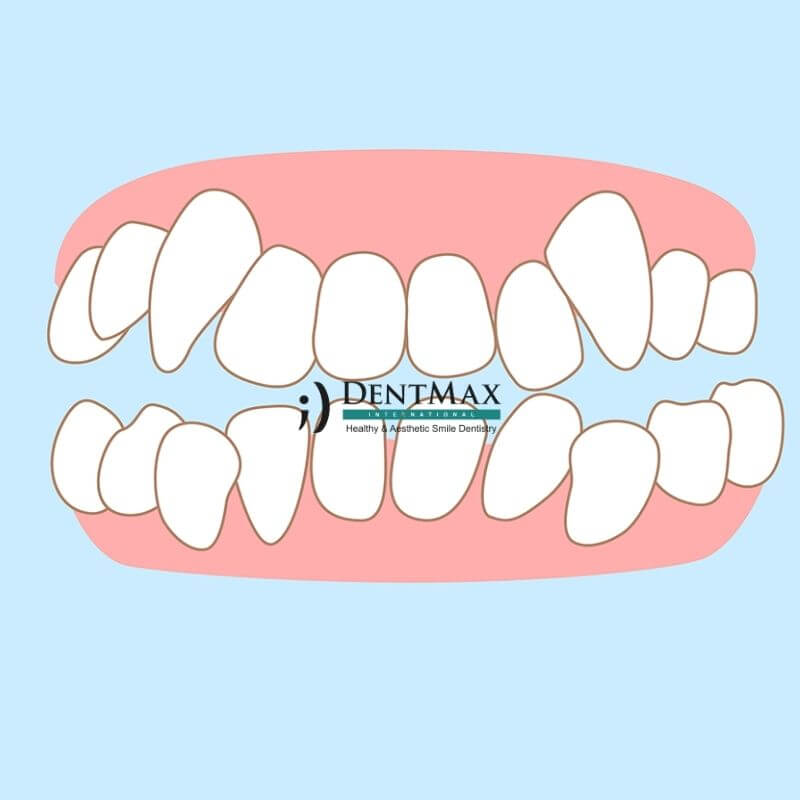 Dentmax