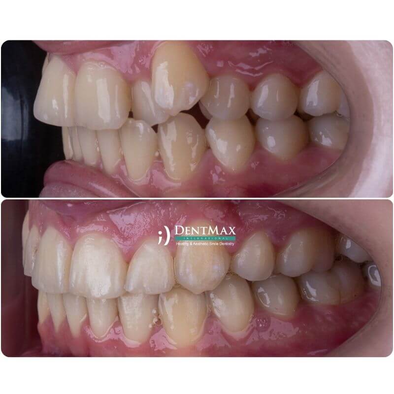 Dentmax
