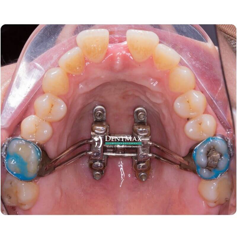 Dentmax