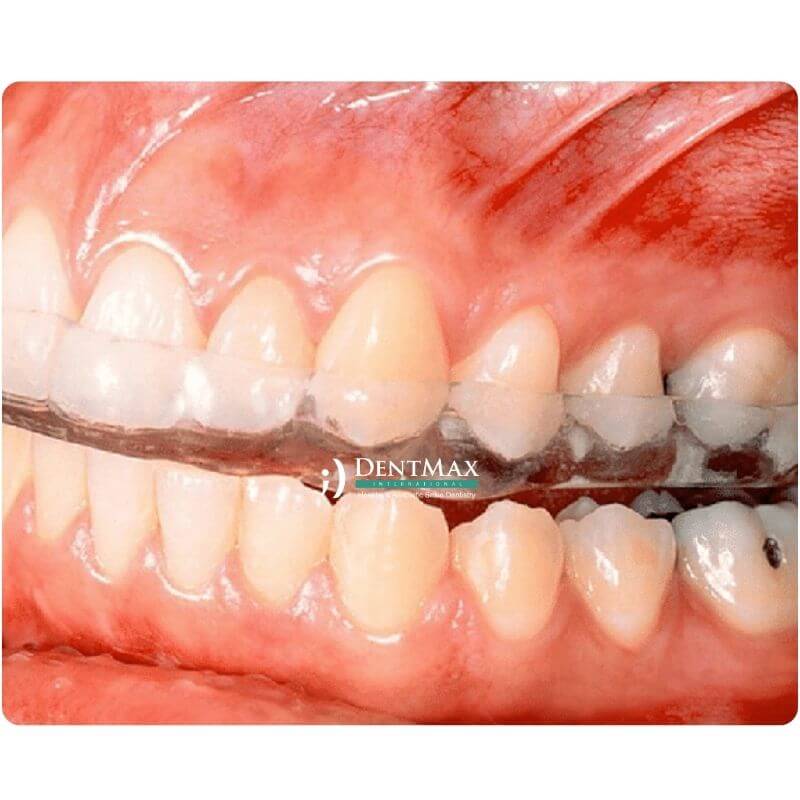 Dentmax