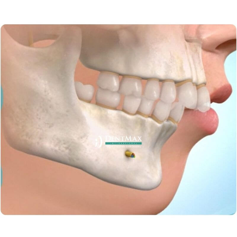 Dentmax