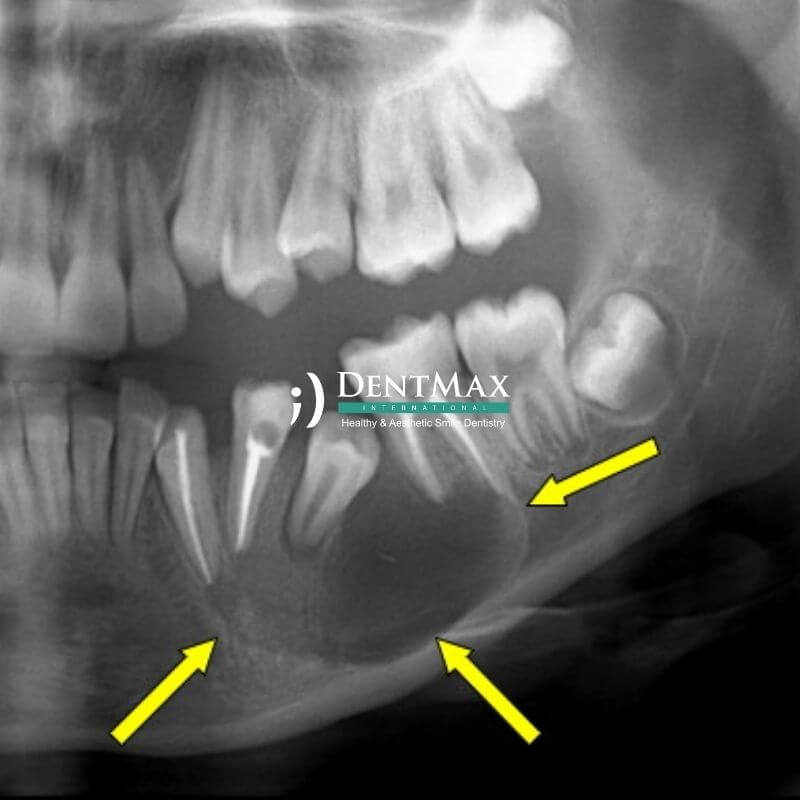Dentmax
