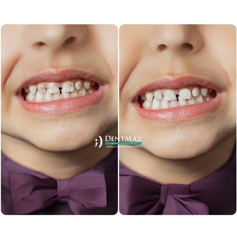 Dentmax