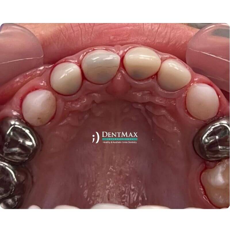 Dentmax