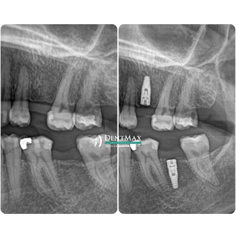 Dentmax