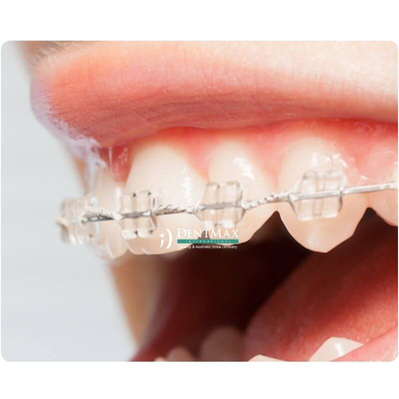 Dentmax