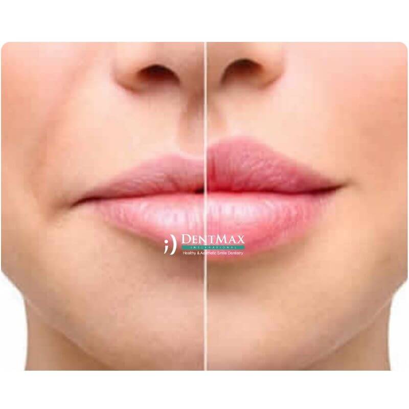 Dentmax