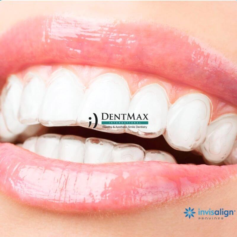 Dentmax