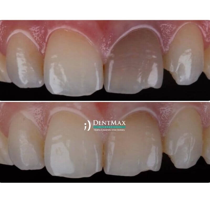 Dentmax