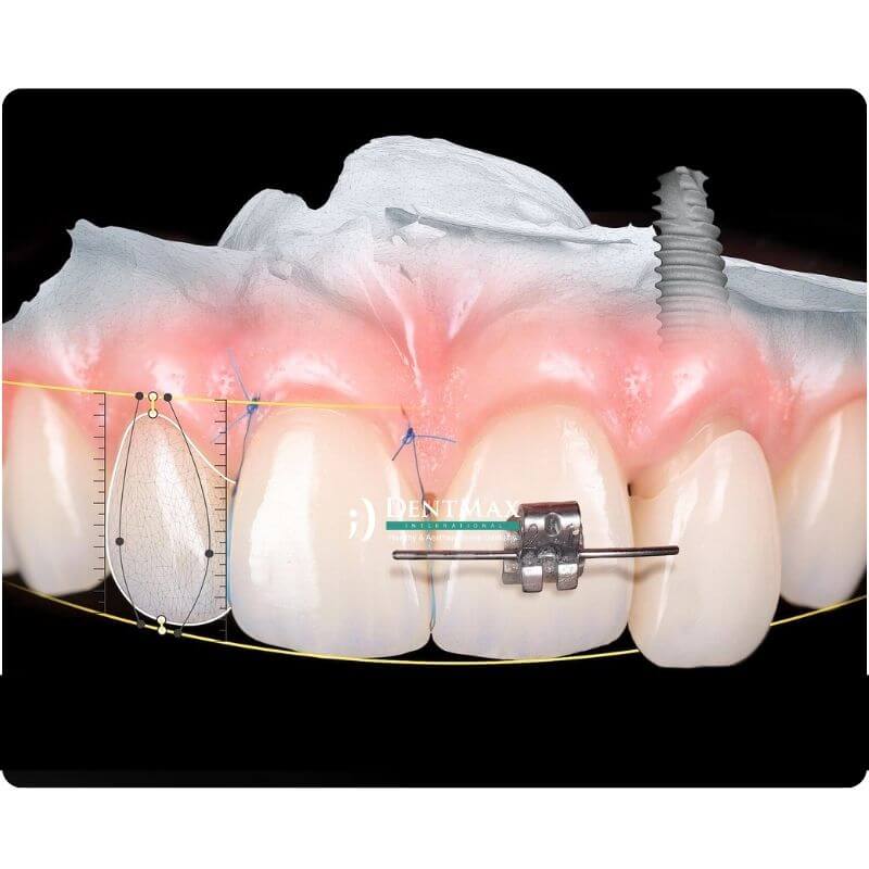 Dentmax