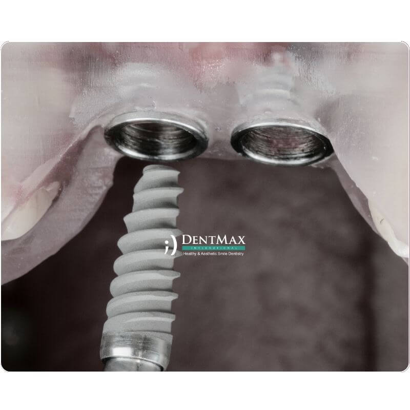 Dentmax