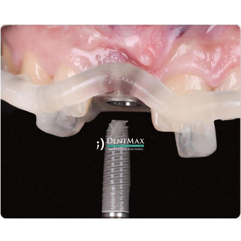 Dentmax