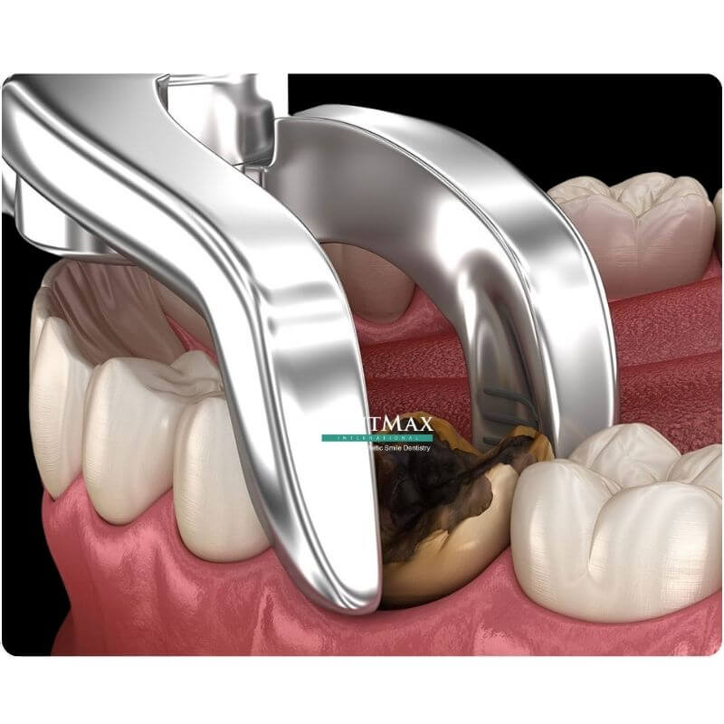 Dentmax