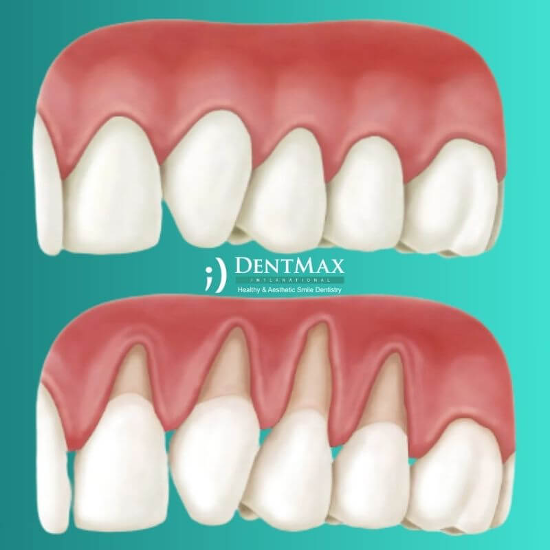 Dentmax