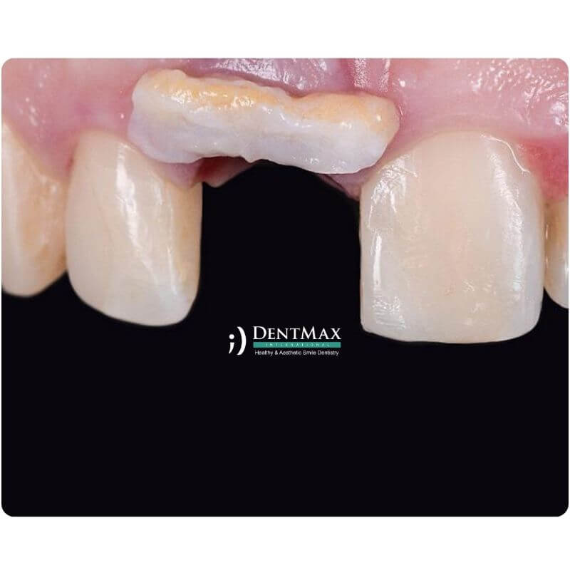 Dentmax