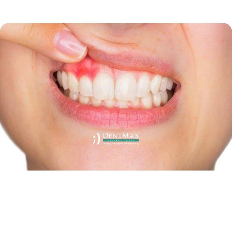Dentmax