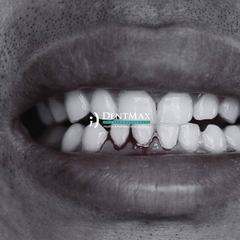 Dentmax