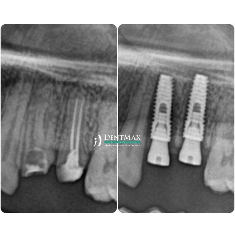 Dentmax