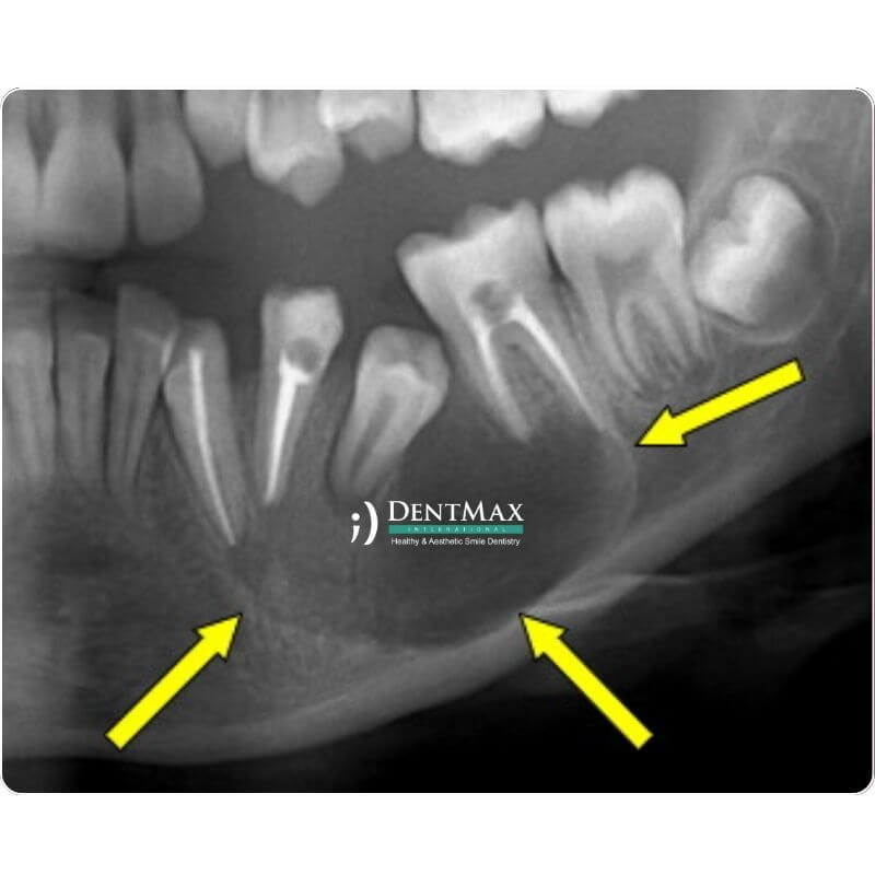 Dentmax