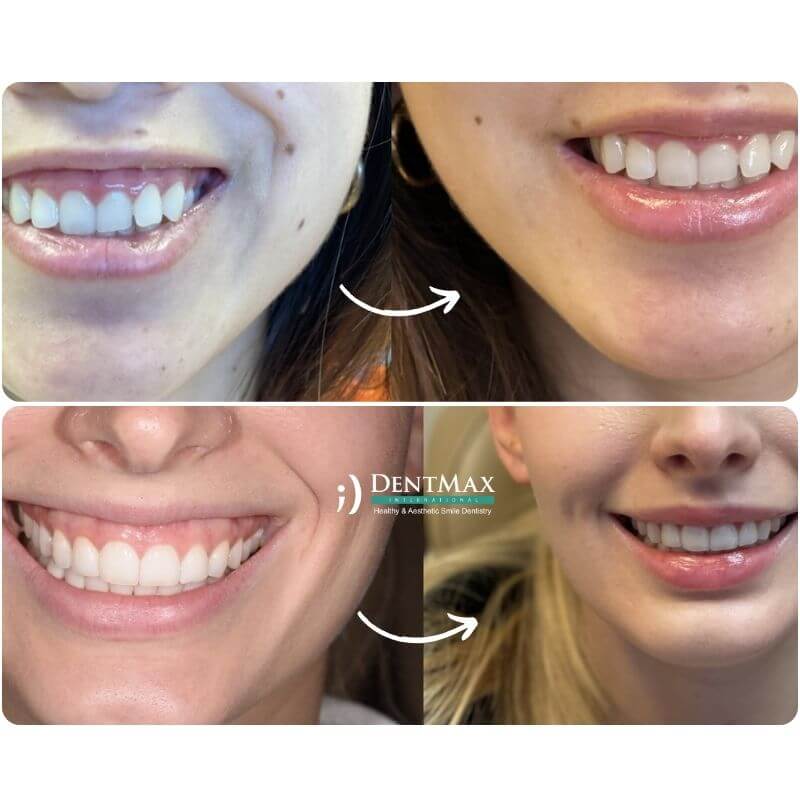 Dentmax