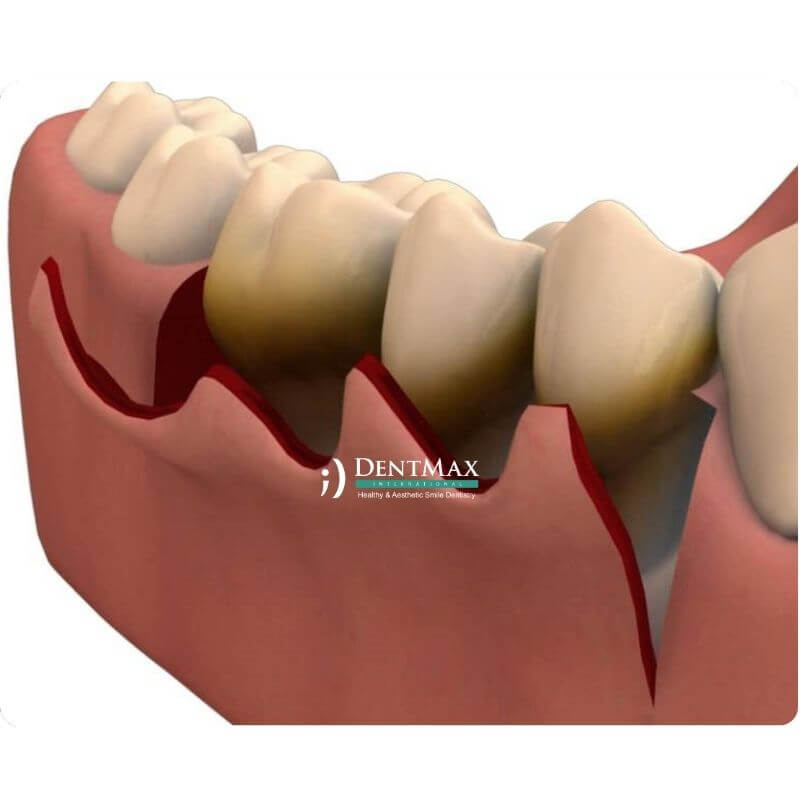 Dentmax