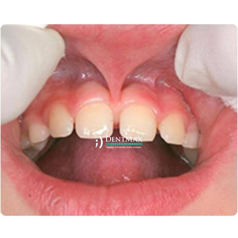 Dentmax