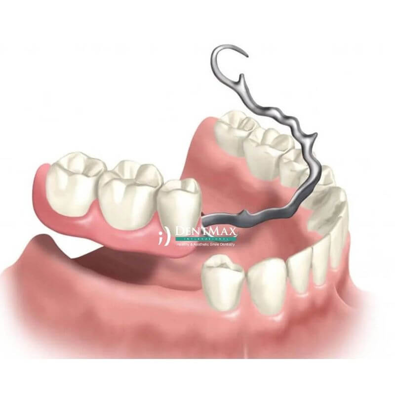 Dentmax
