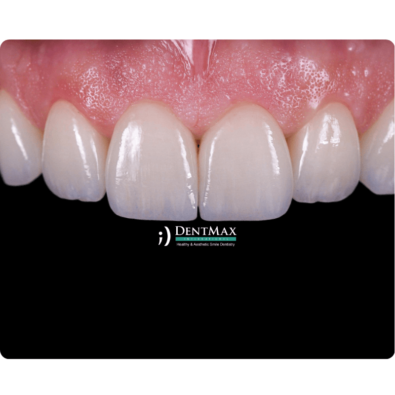 Dentmax