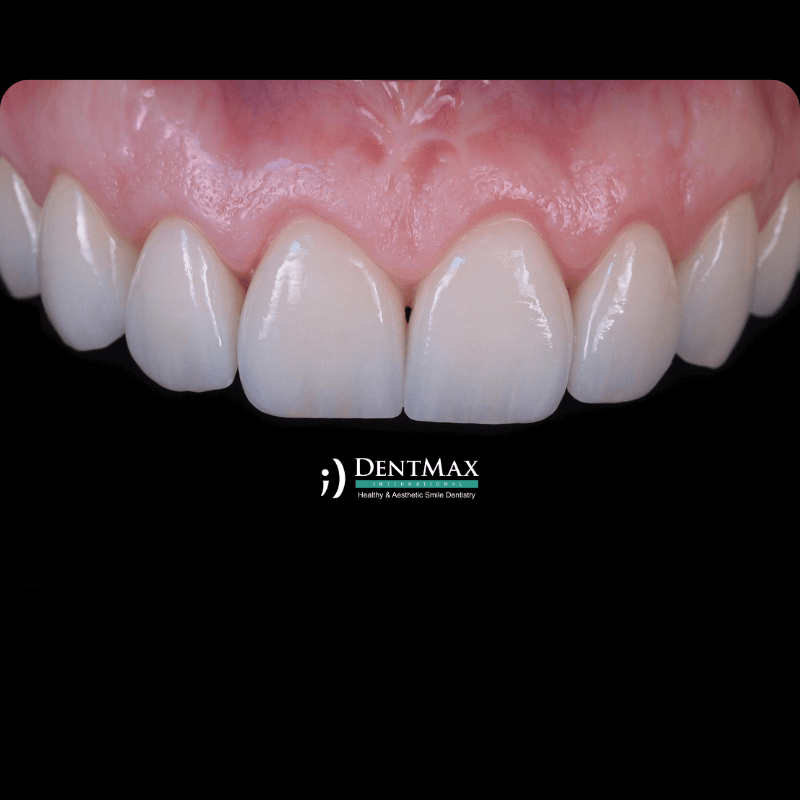 Dentmax