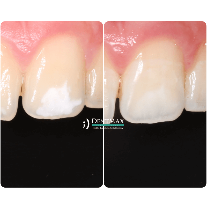 Dentmax