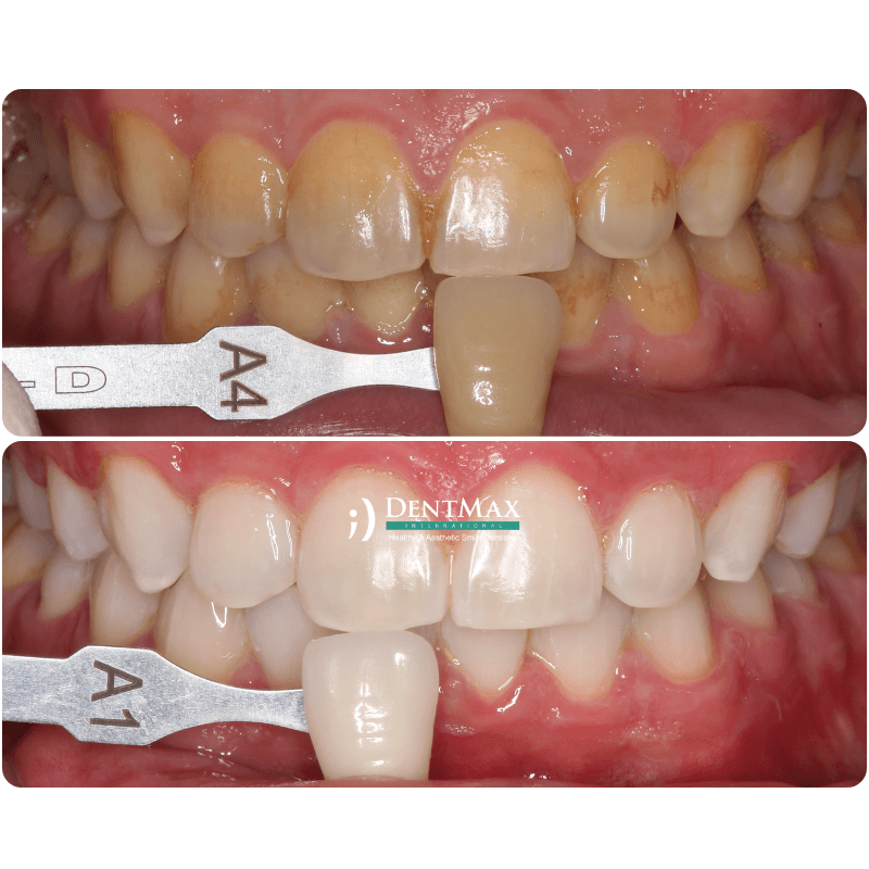 Dentmax