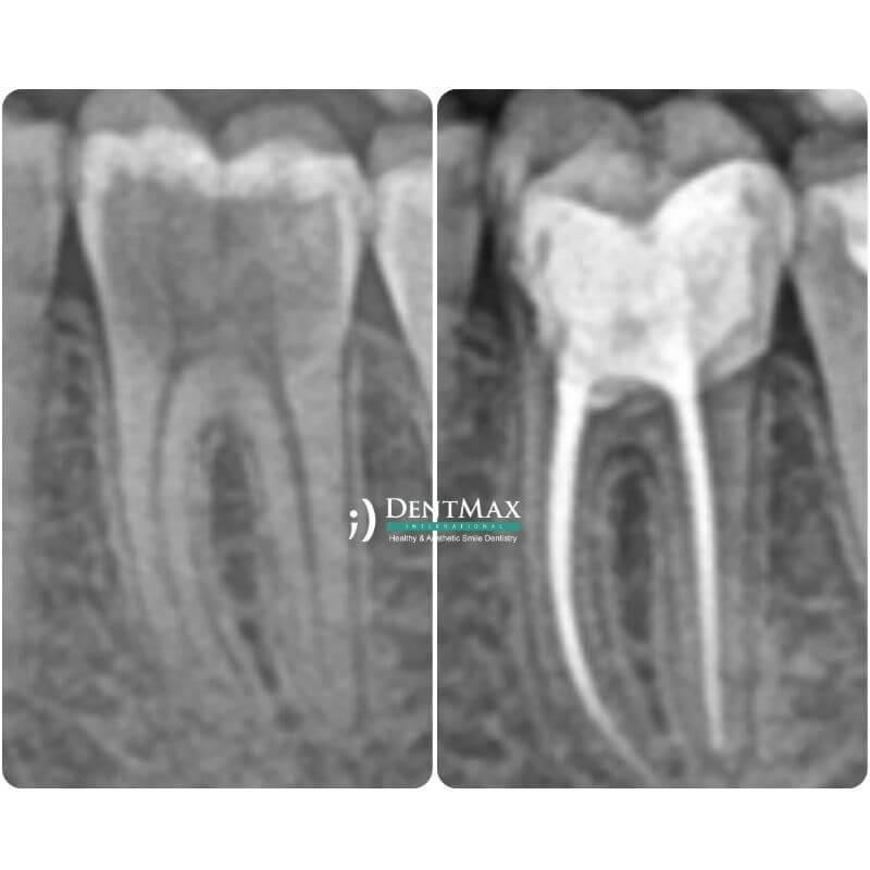 Dentmax