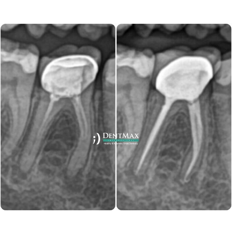 Dentmax