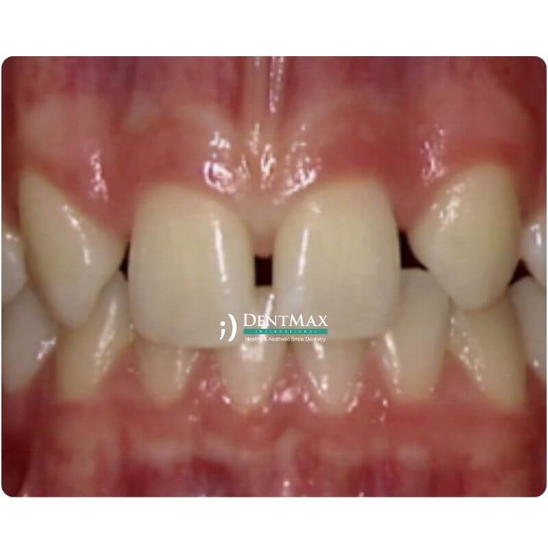 Dentmax