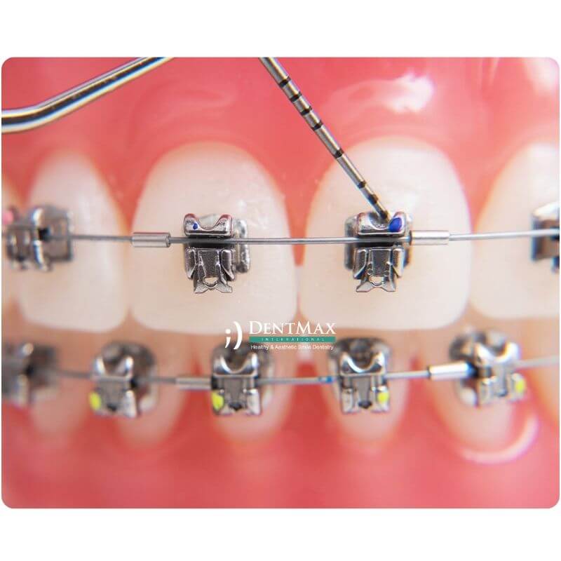 Dentmax