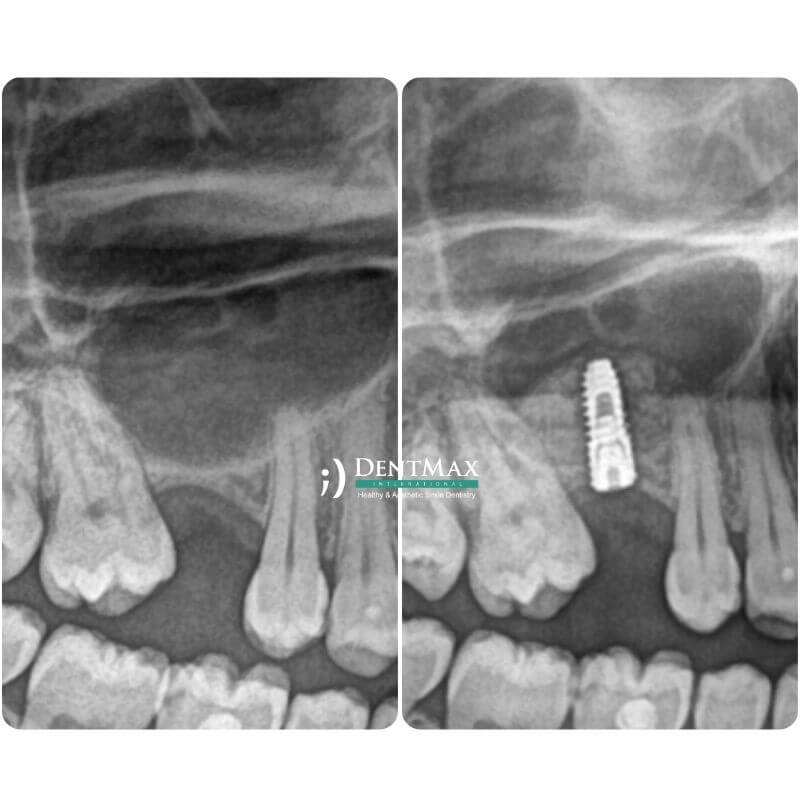 Dentmax