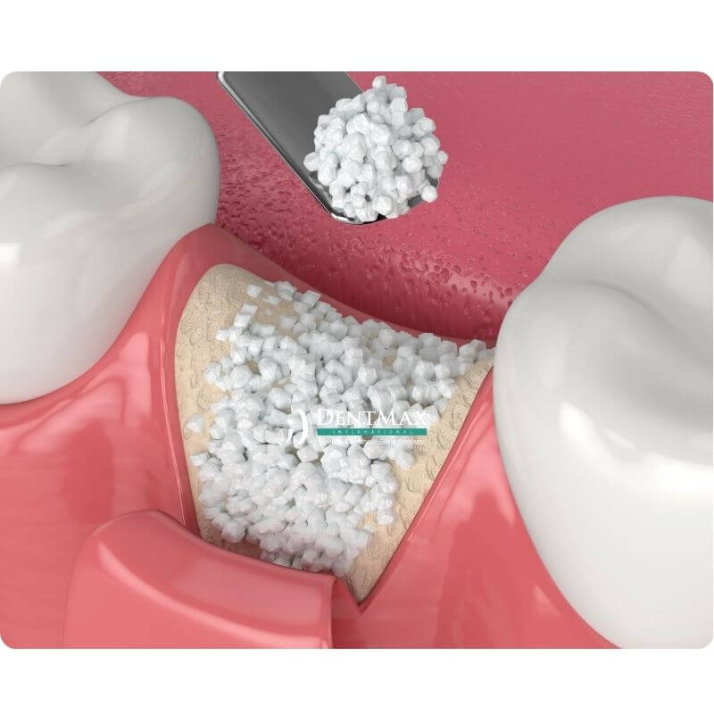 Dentmax