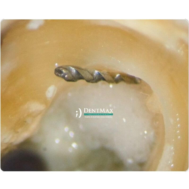 Dentmax