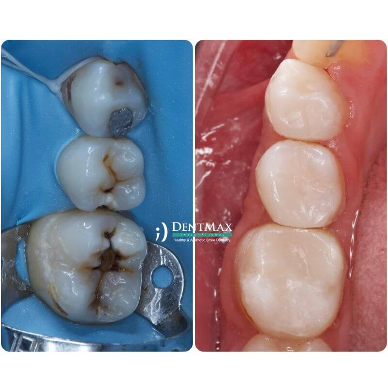 Dentmax