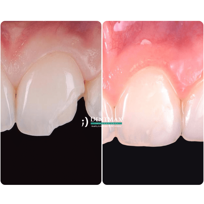 Dentmax