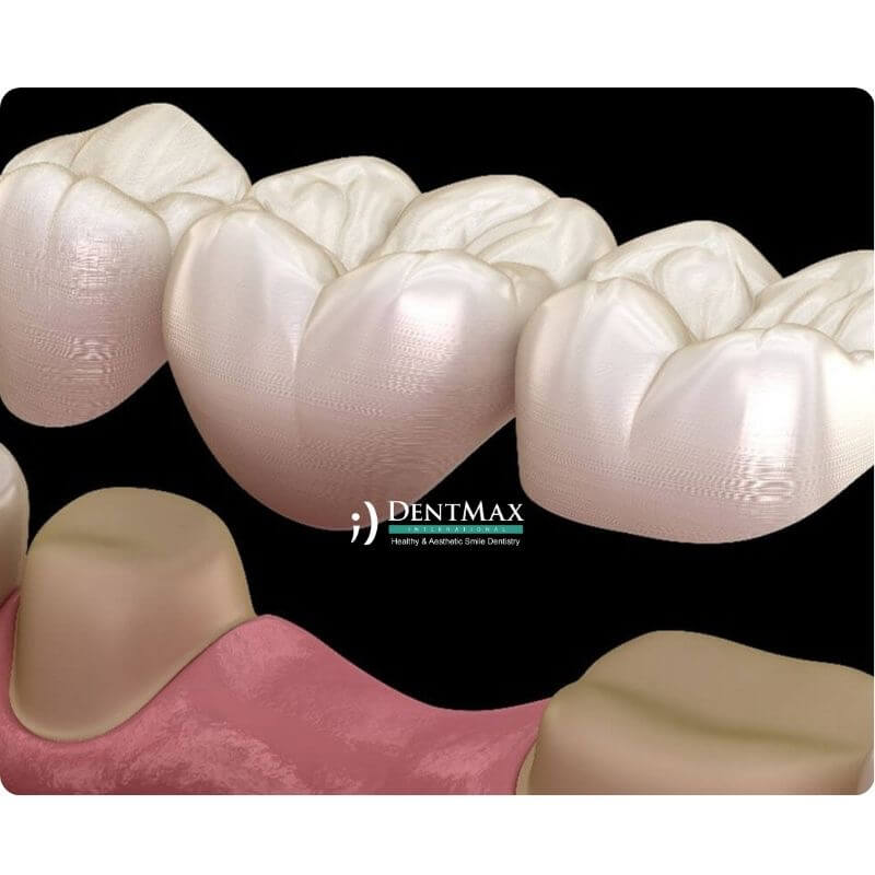 Dentmax