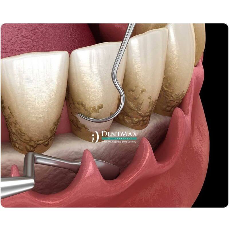 Dentmax