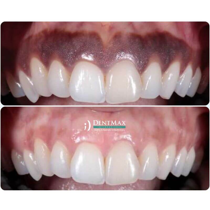 Dentmax