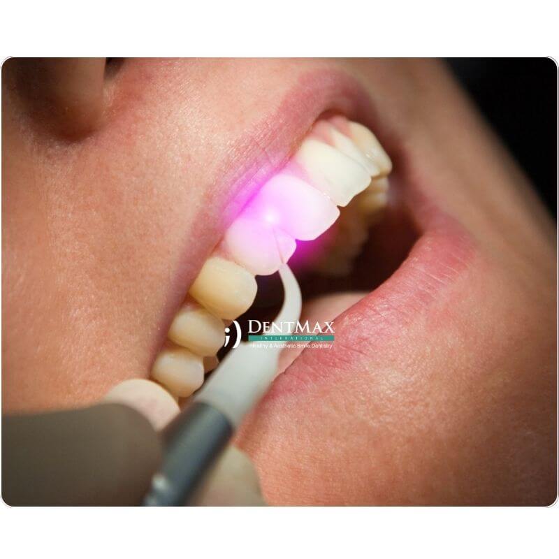 Dentmax